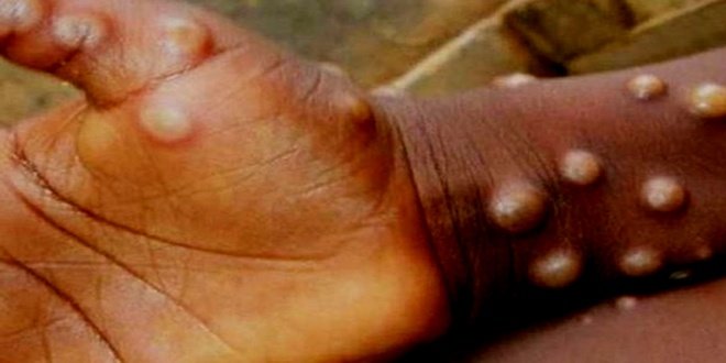 RDC : Plus de 192 cas de décès de la maladie Monkey pox